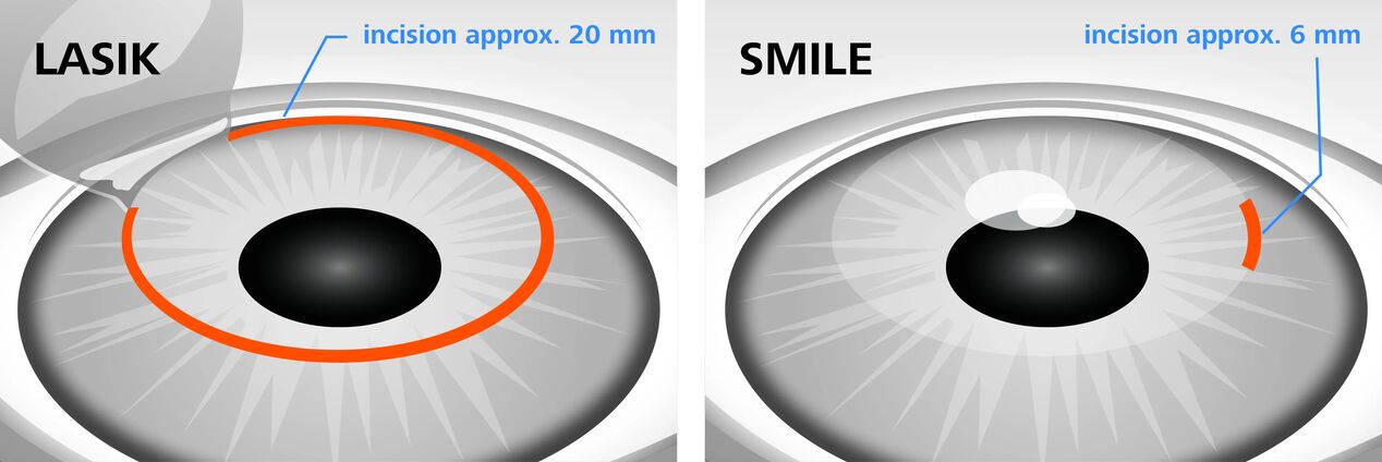 Сравнение на методите за лазерна корекция на зрението LASIK и SMILE